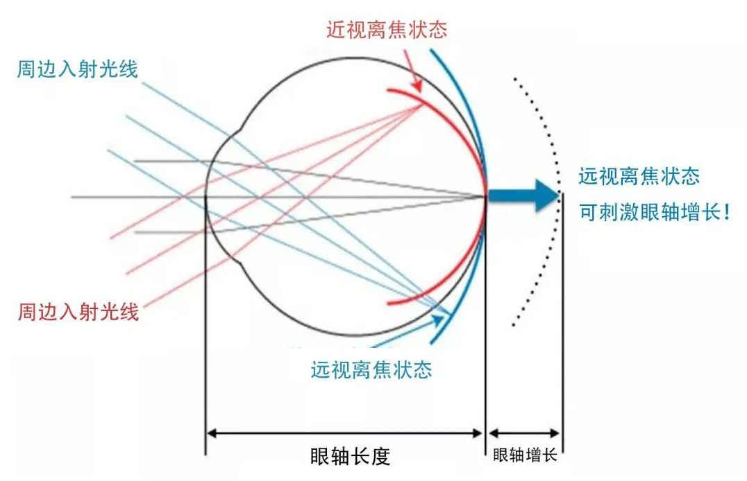 眼球的"周边远视离焦状态"也是目前近视发病机制的主流学说.